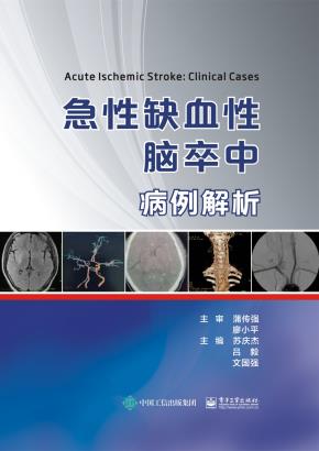 急性缺血性脑卒中病例解析